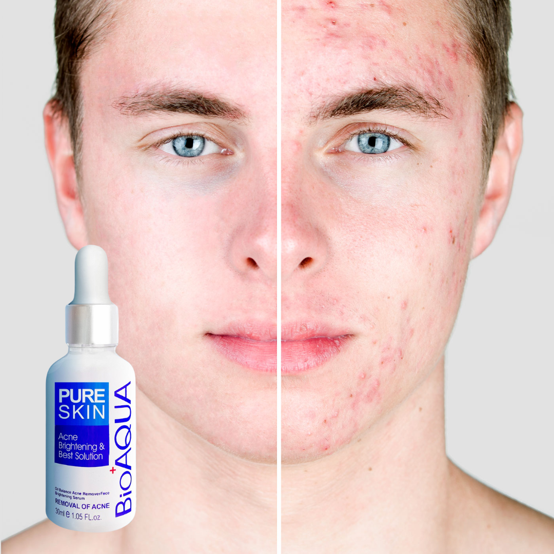Sérum Facial Antiacné BioAqua 2X1 : Nutre, Renueva y Purifica tu piel para lograr un rostro impecable